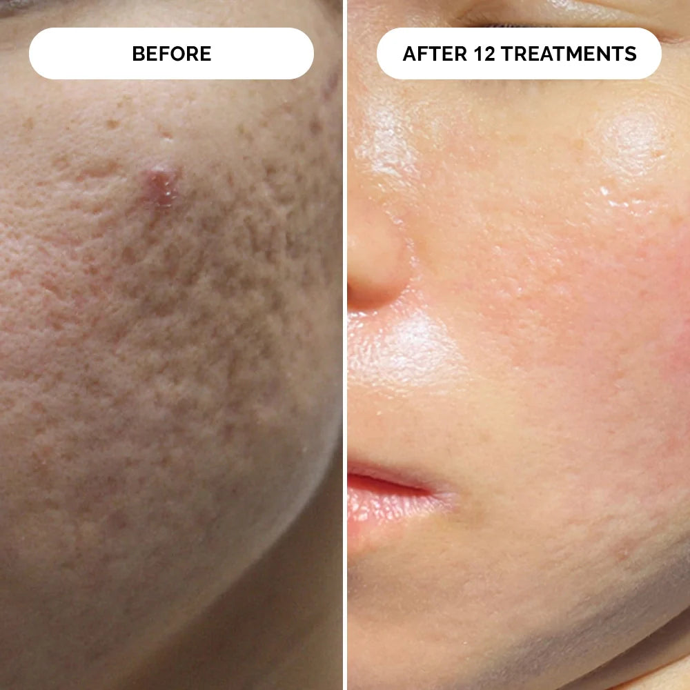 PDRN Micro-Infusion Skin Booster