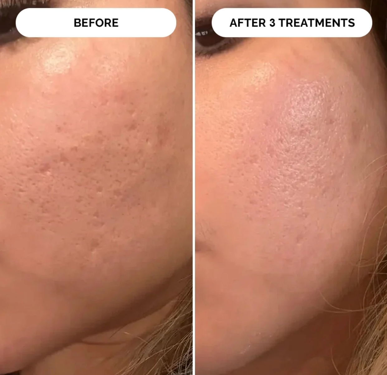 PDRN Micro-Infusion Skin Booster