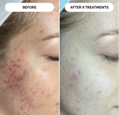 PDRN Micro-Infusion Skin Booster