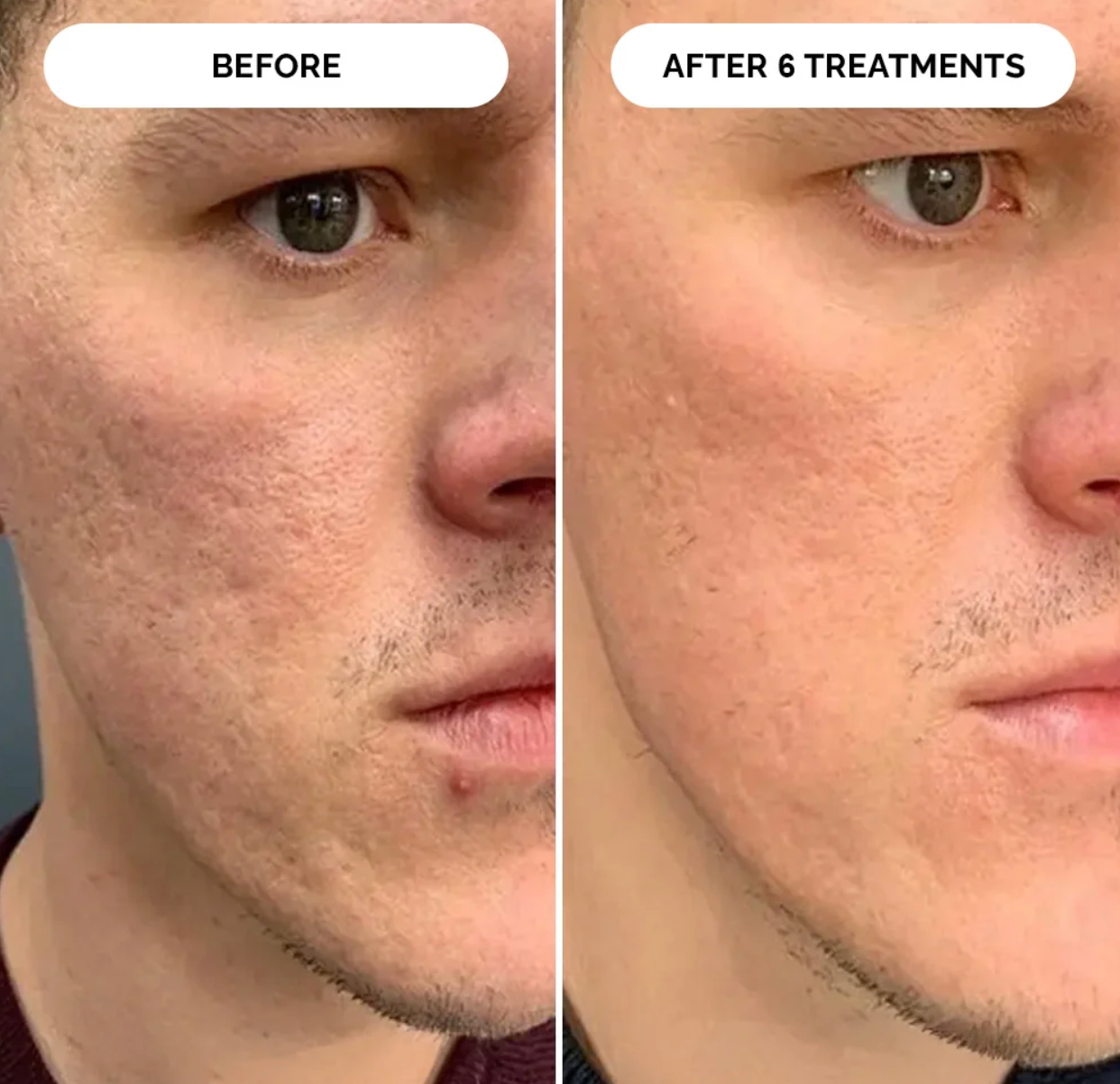 PDRN Micro-Infusion Skin Booster