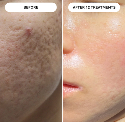 PDRN Micro-Infusion Skin Booster